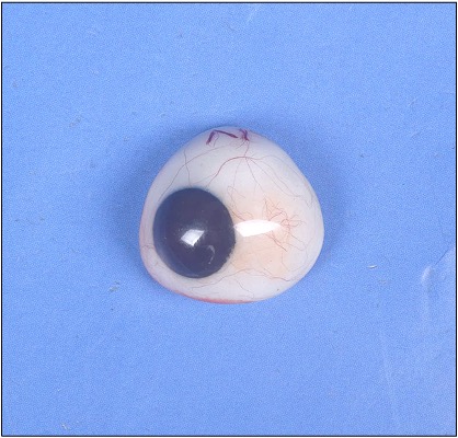 Artificial Eye (Prosthetic Eye) 