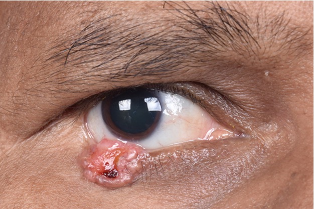 Ocular Oncology (Lumps & Bumps Around the Eyes) 