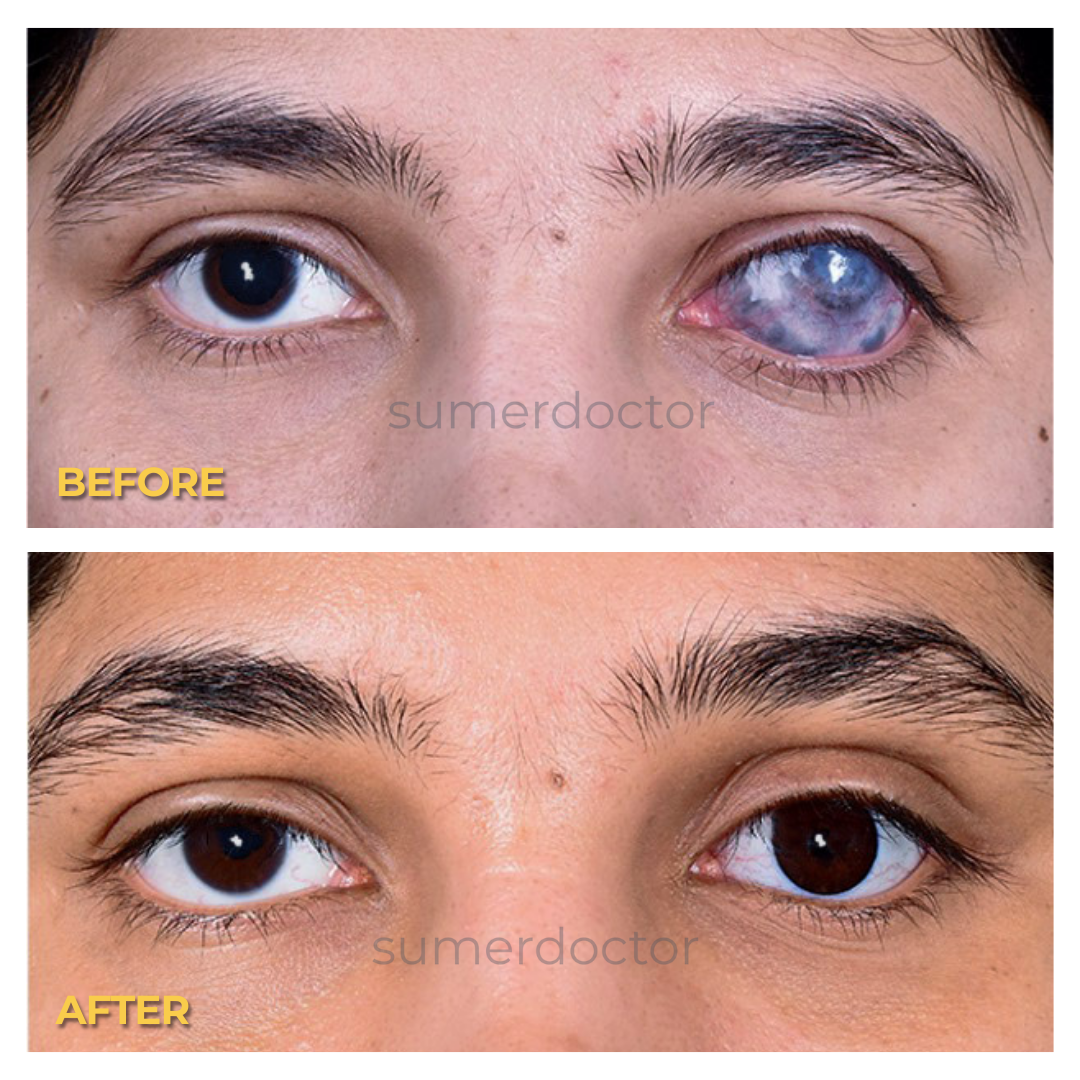 Blind Eye and Artificial Eye