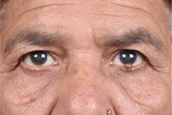 9 Signs You Might Need Oculoplastic Surgery (Oculoplasty)
