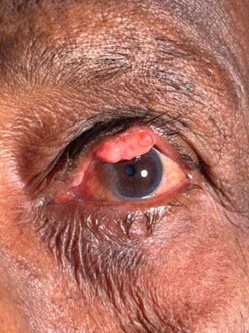 Eyelid Lumps or Growths