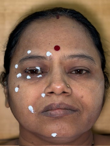 Eyelid and Facial Spasms