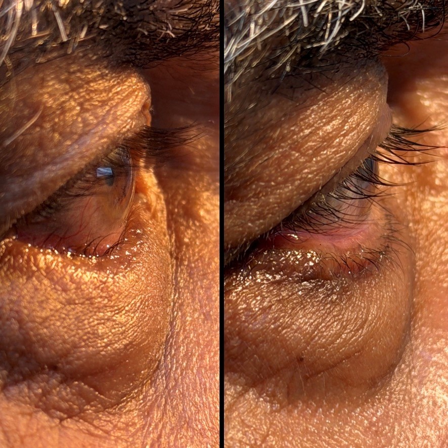 Noticeable Eye Bulging
