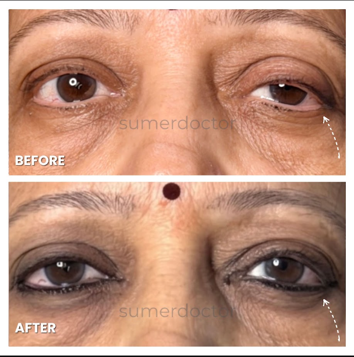 ptosis surgery