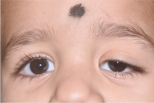 Congenital Ptosis
