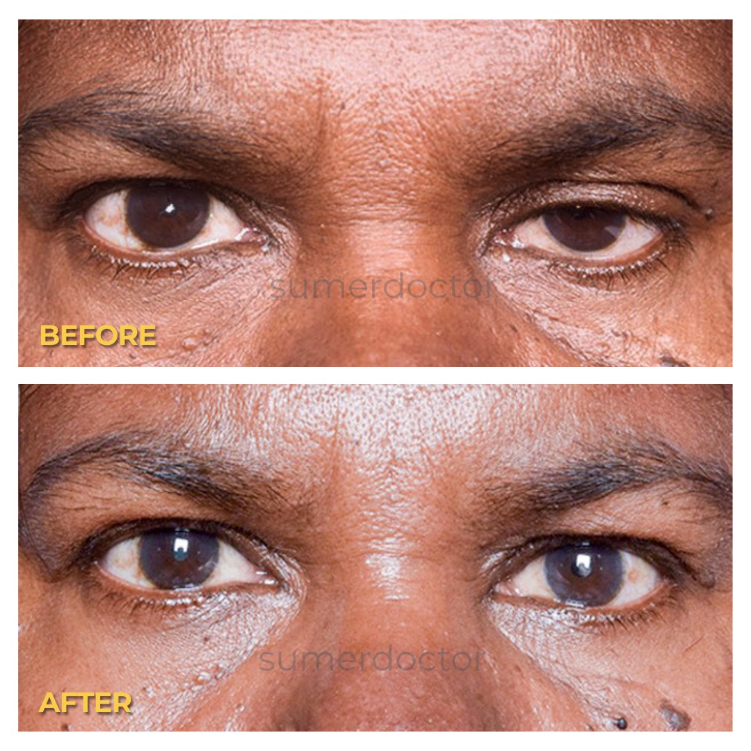Droopy Eyelids (Ptosis): Why It Happens and How to Fix It