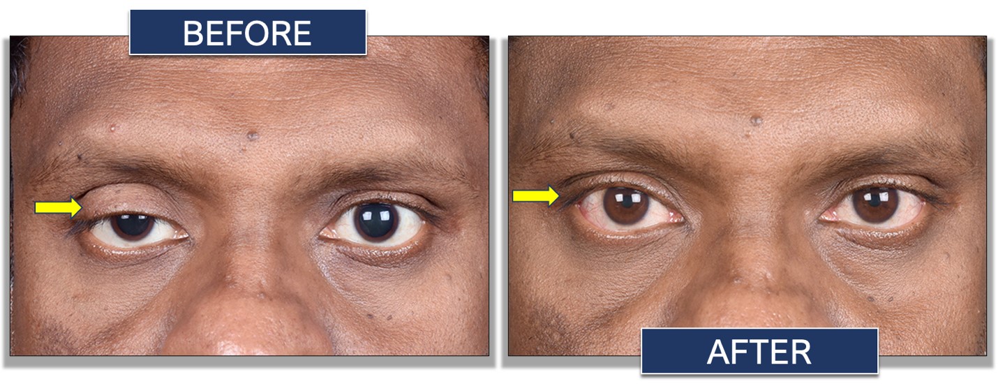 Levator Advancement Surgery before after