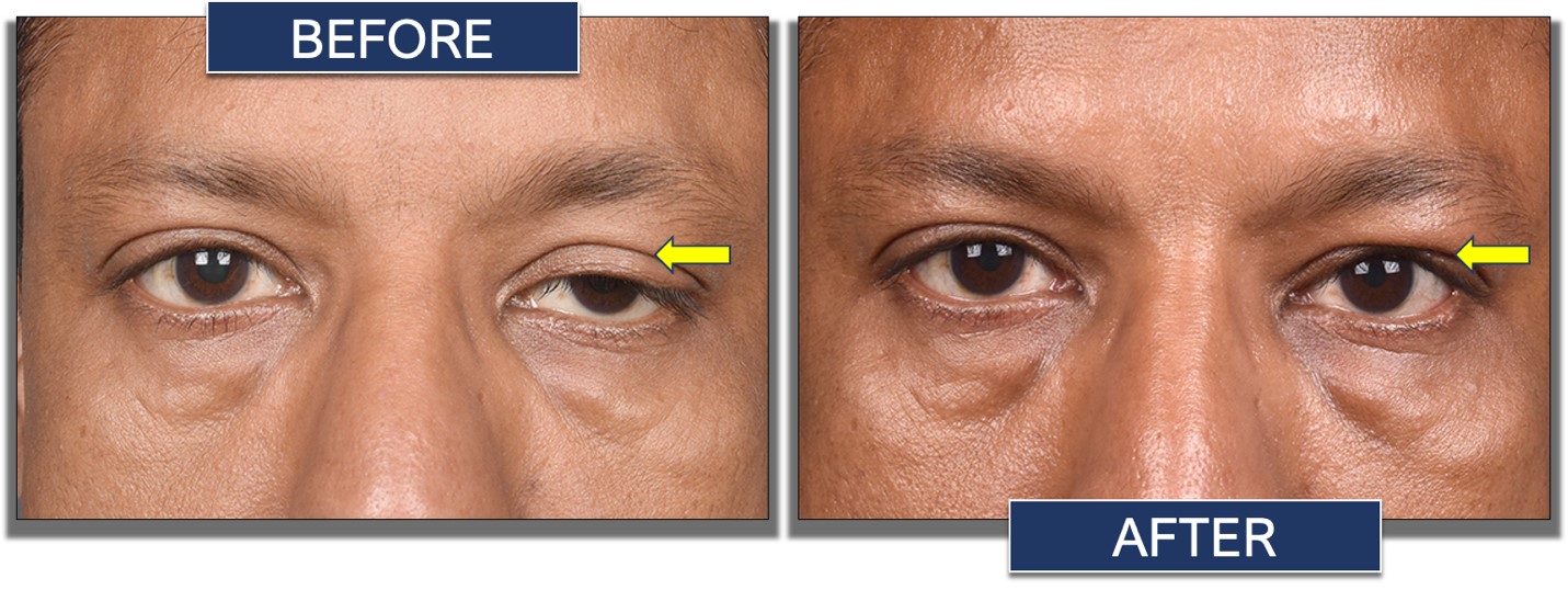 Levator Advancement Surgery