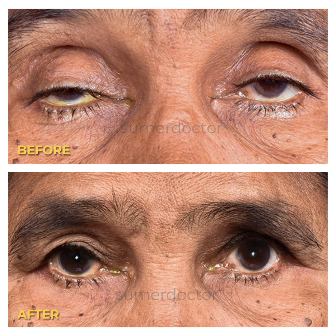 Ptosis