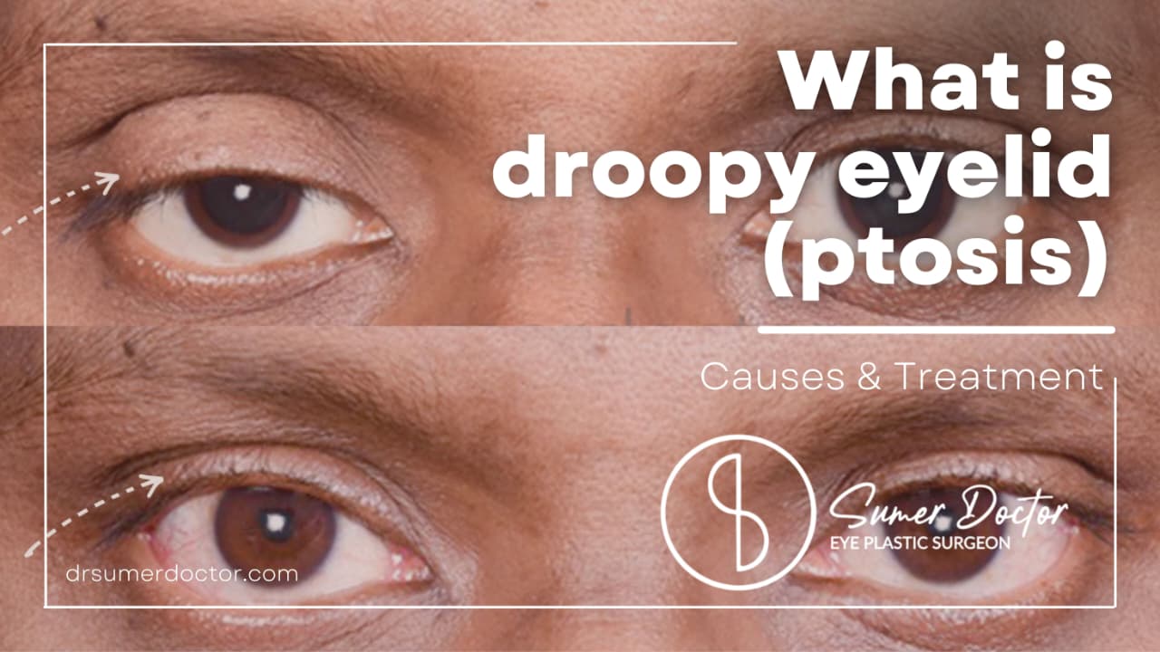 Droopy Eyelid(Ptosis): Causes, Symptoms & When is Treatment Needed