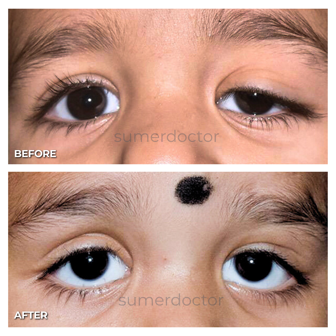 ptosis surgery in Mumbai