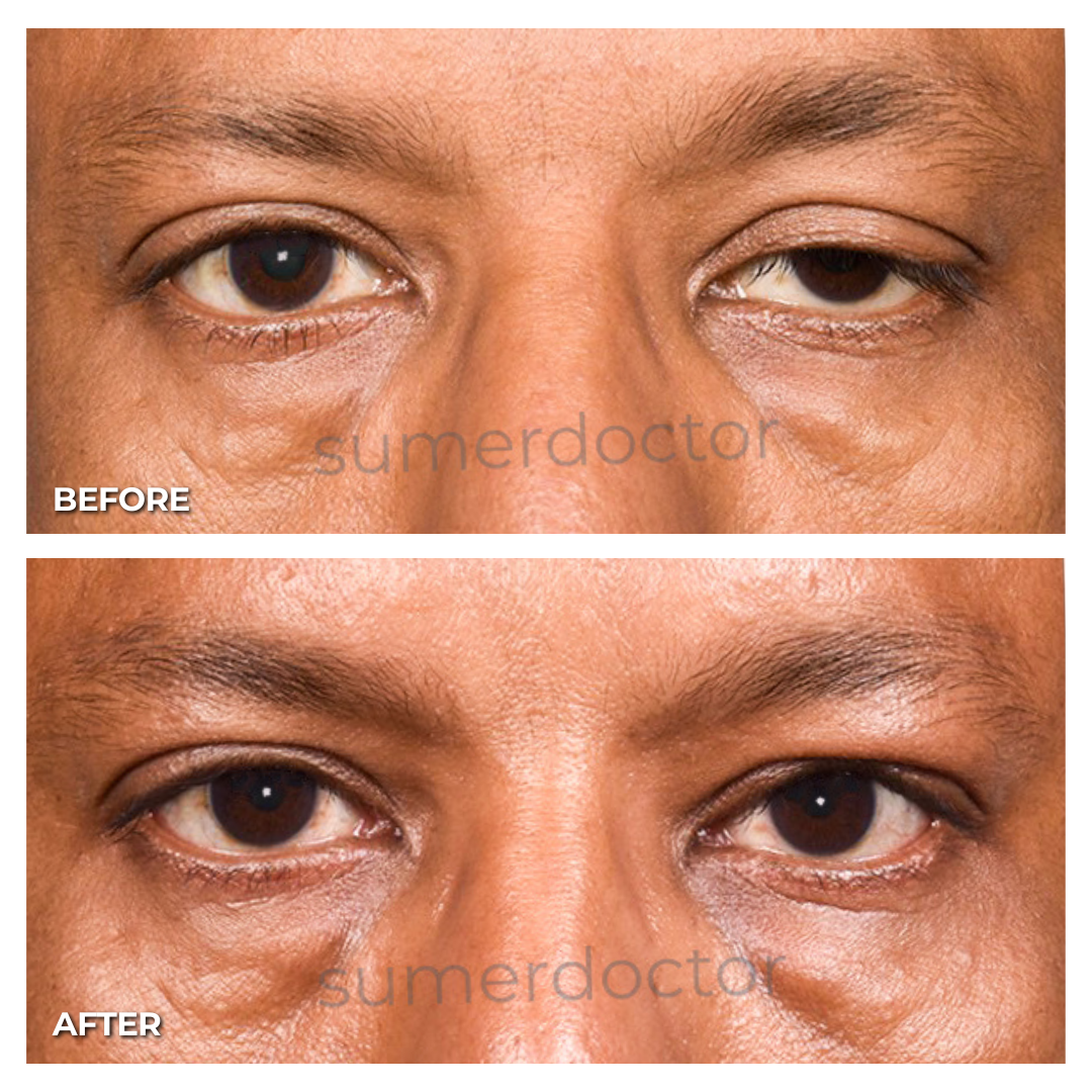 ptosis surgery