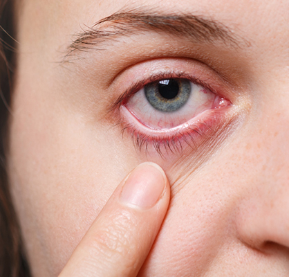 Tear Duct Surgery (DCR)