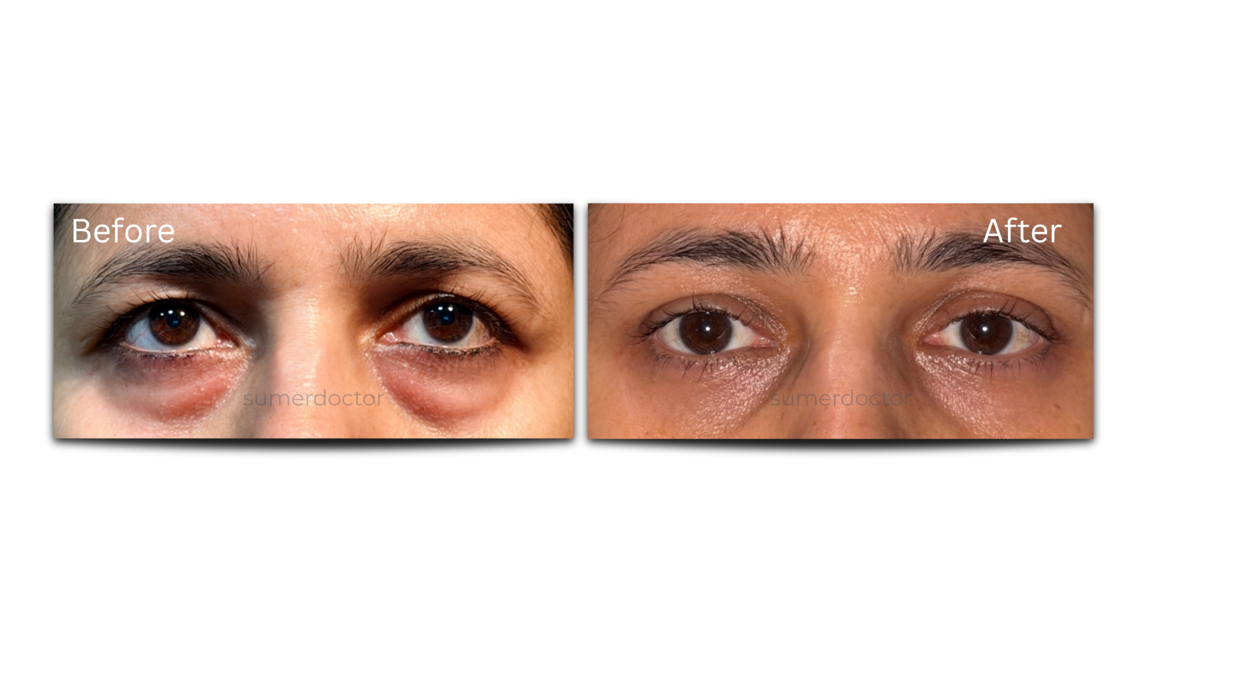 Blepharoplasty1