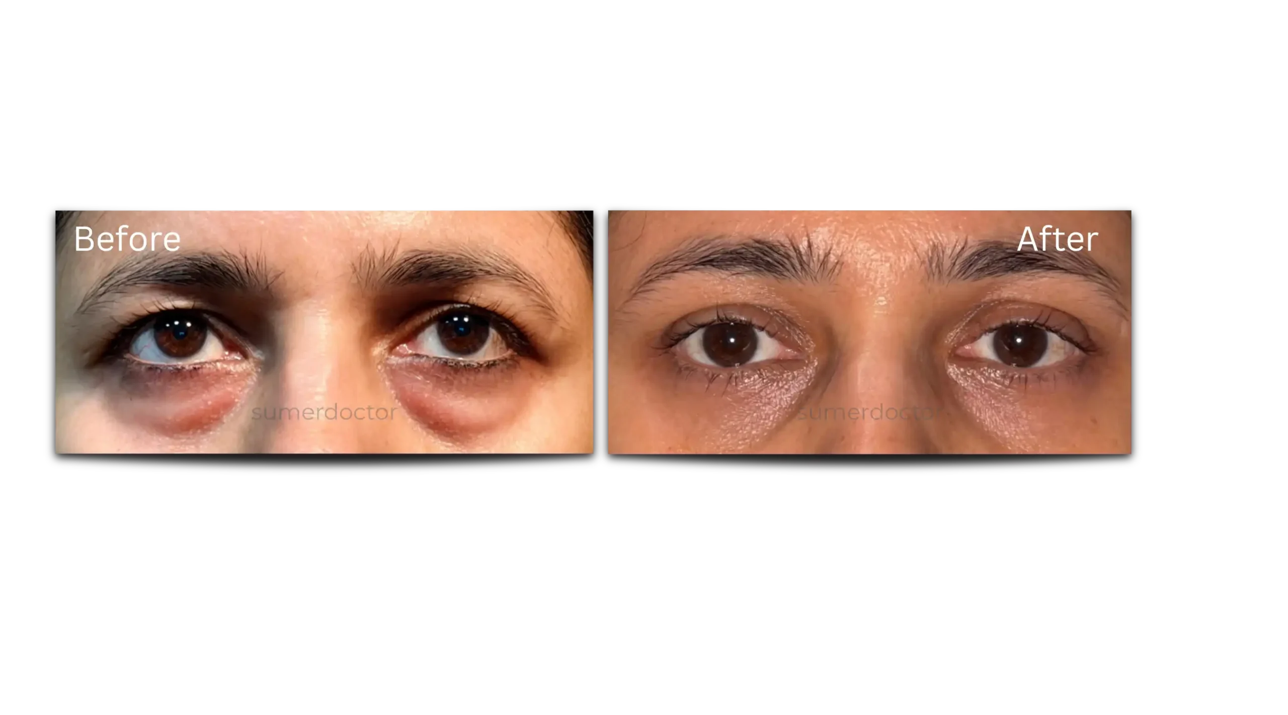 Blepharoplasty1