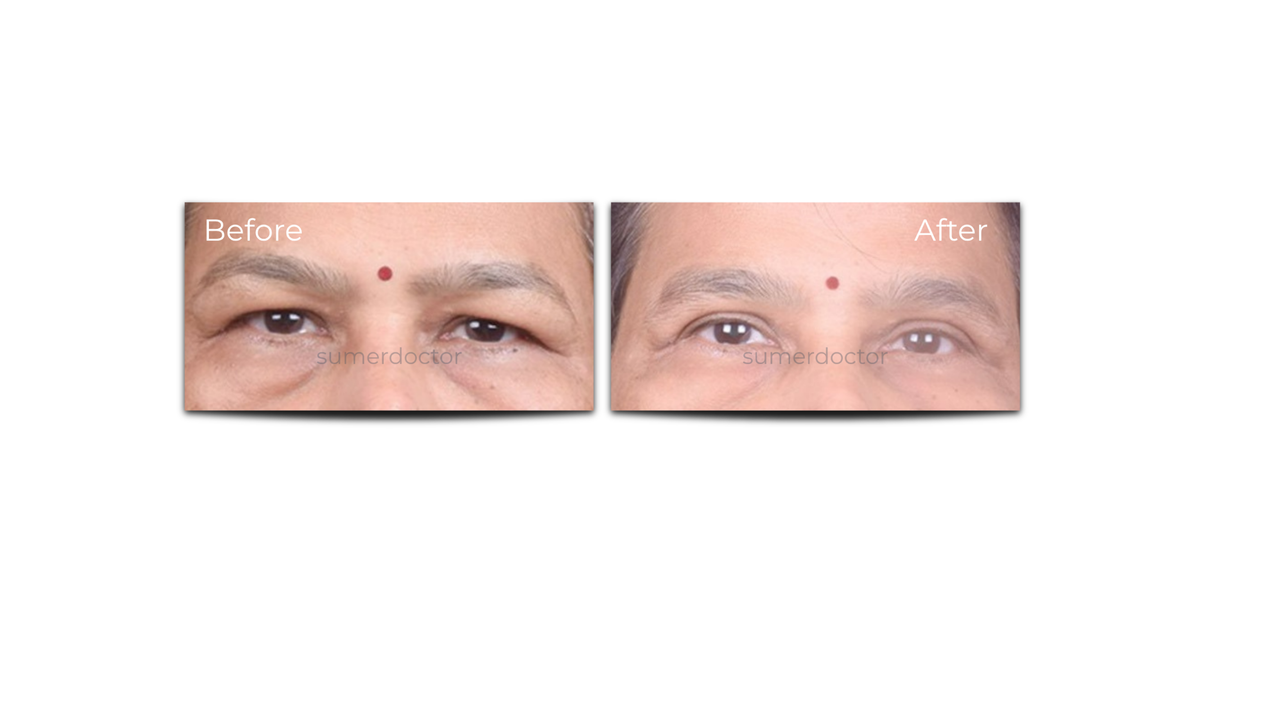 Blepharoplasty2