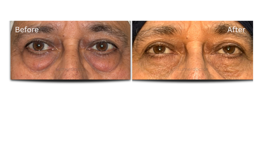 Blepharoplasty3