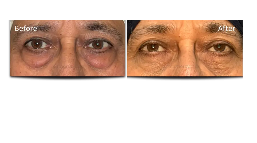 Blepharoplasty3