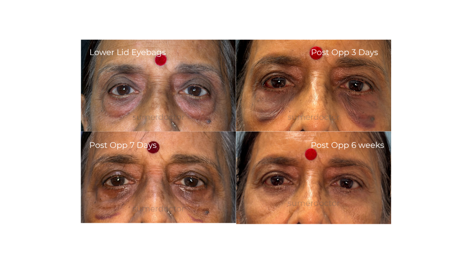 Blepharoplasty5