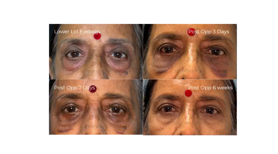 Blepharoplasty5
