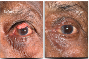 Ocular2