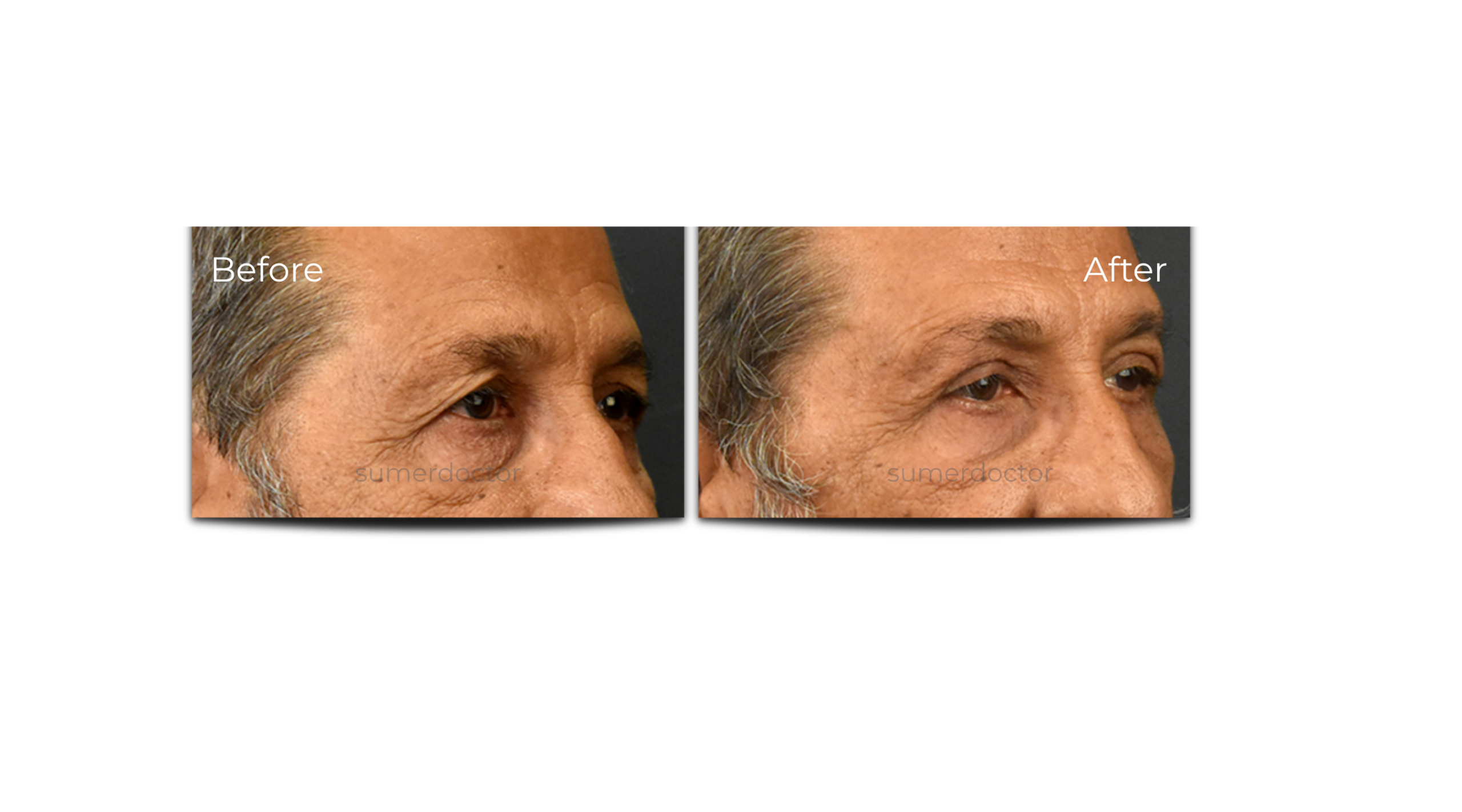 Blepharoplasty4