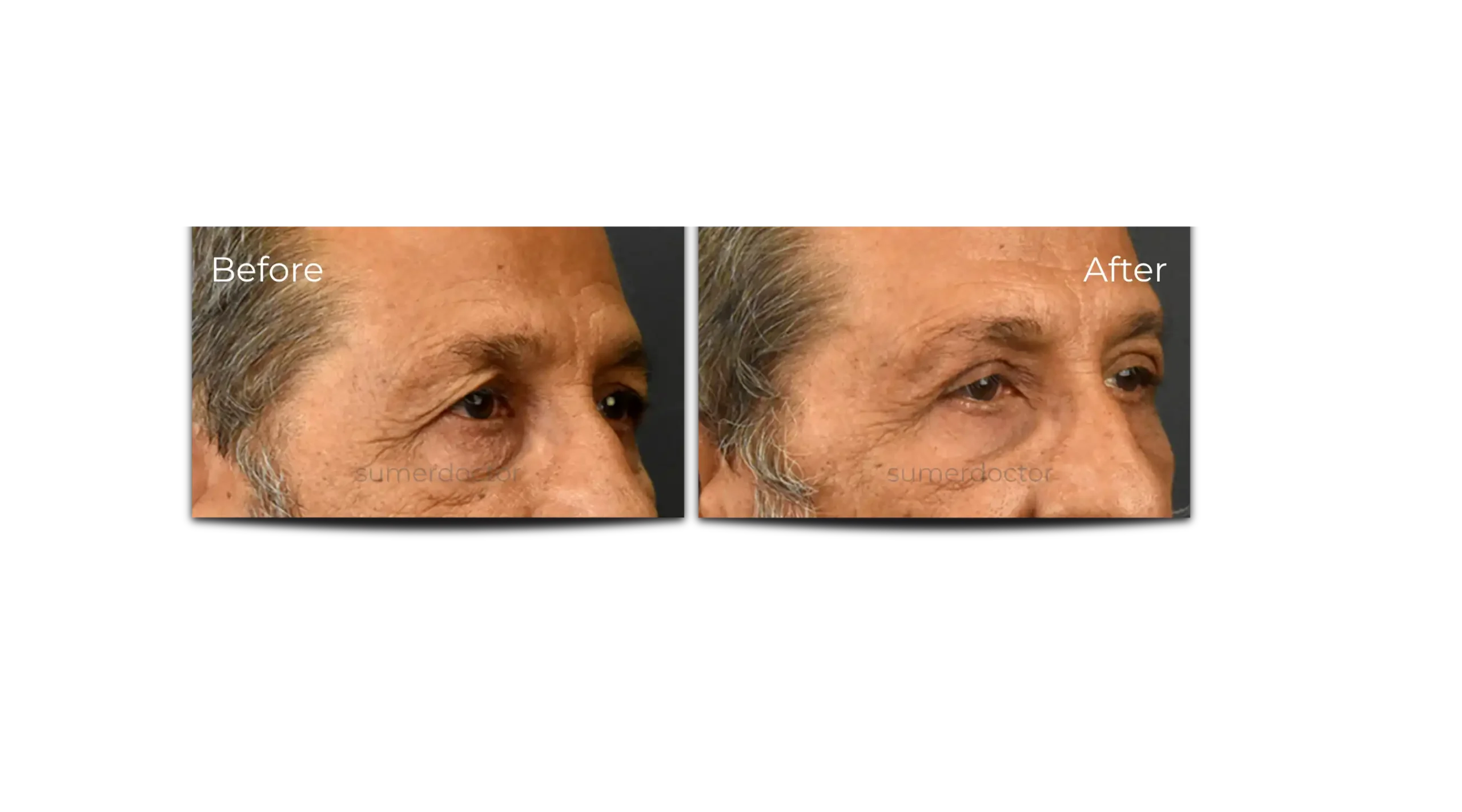 Blepharoplasty4