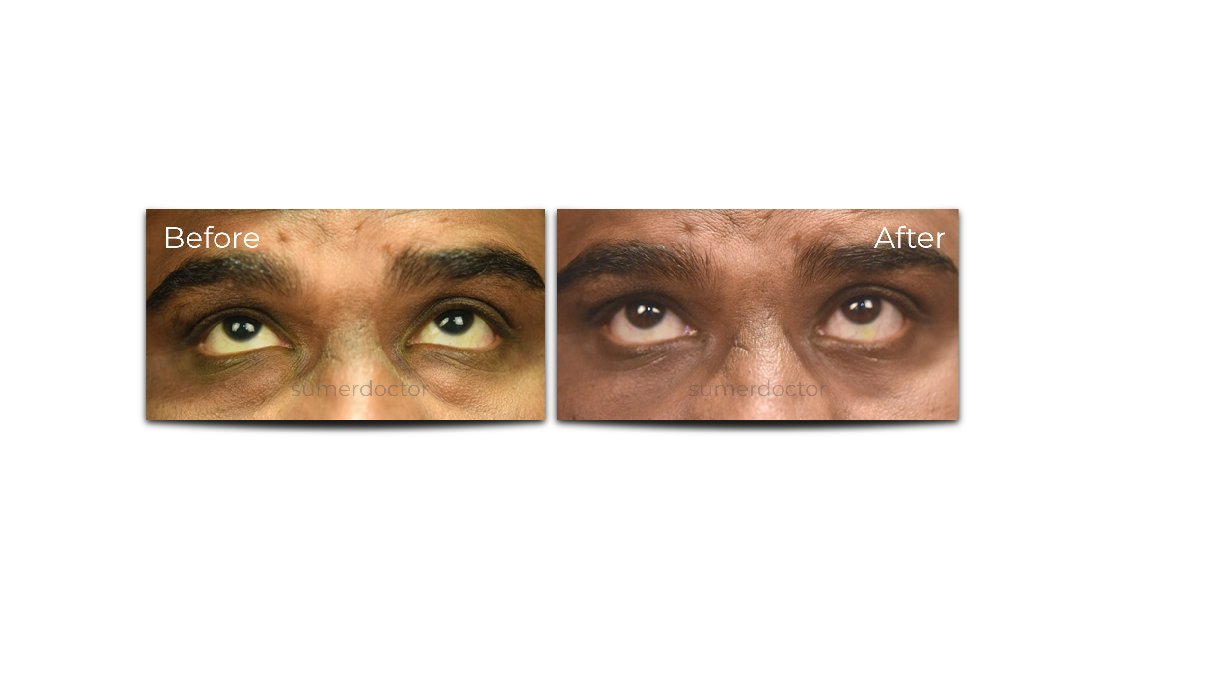 Blepharoplasty6