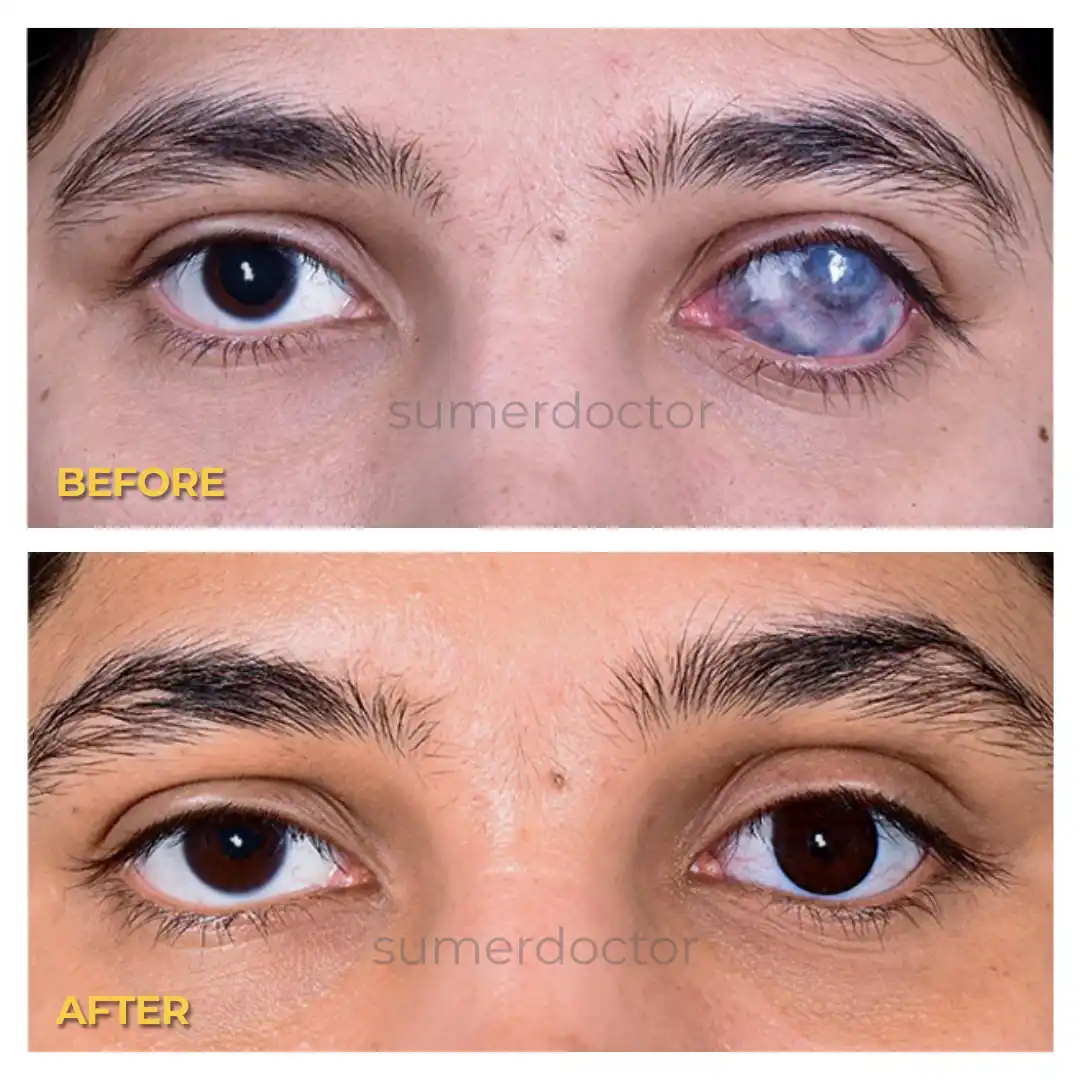 Blind Eye and Artificial Eye