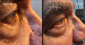 Entropion, Ectropion & Facial Palsy2