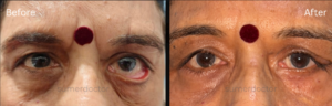 Entropion, Ectropion & Facial Palsy3