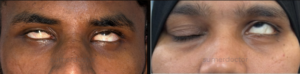 Entropion, Ectropion & Facial Palsy5