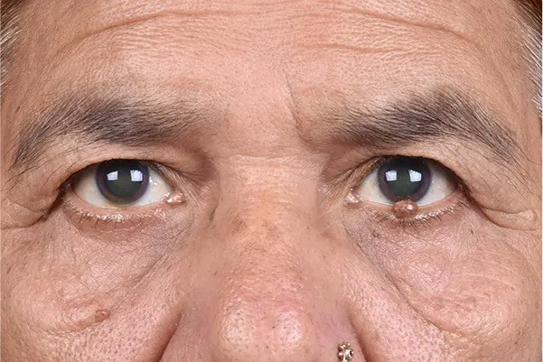 9 Signs You Might Need Oculoplastic Surgery (Oculoplasty)