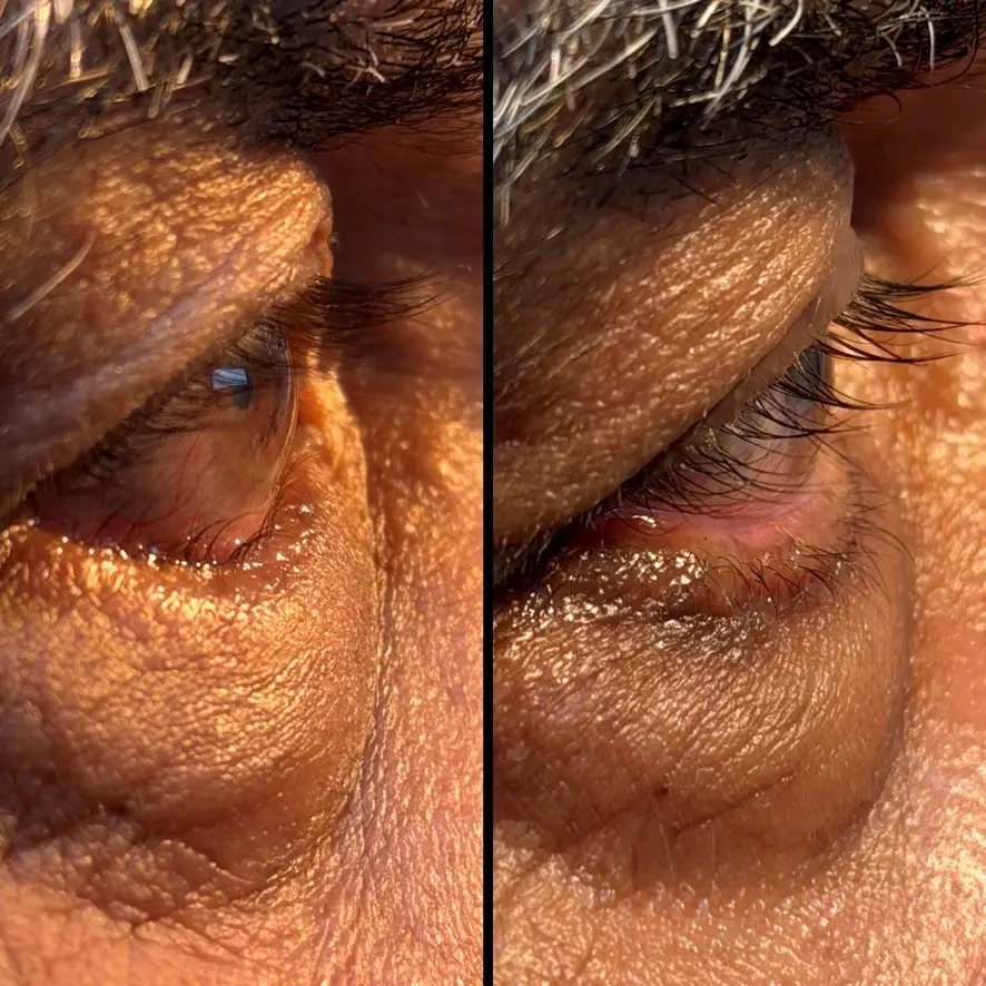 Noticeable Eye Bulging