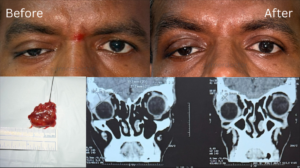 Orbital Surgery3