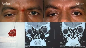 Orbital Surgery3