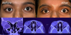 Orbital Surgery4