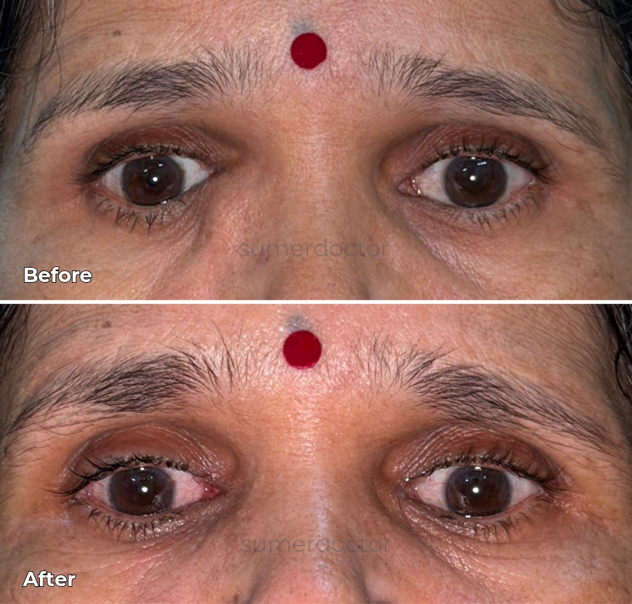 Tear Duct Surgery (DCR)