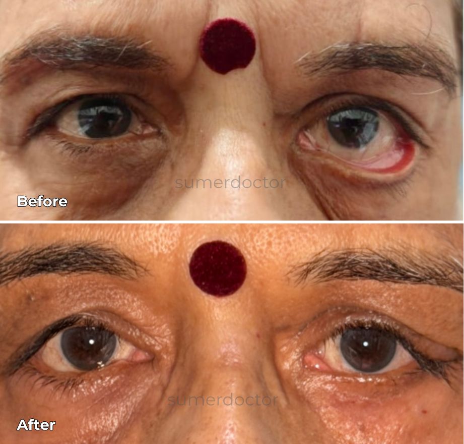 Eyelid Malposition (Entropion / Ectropion) 