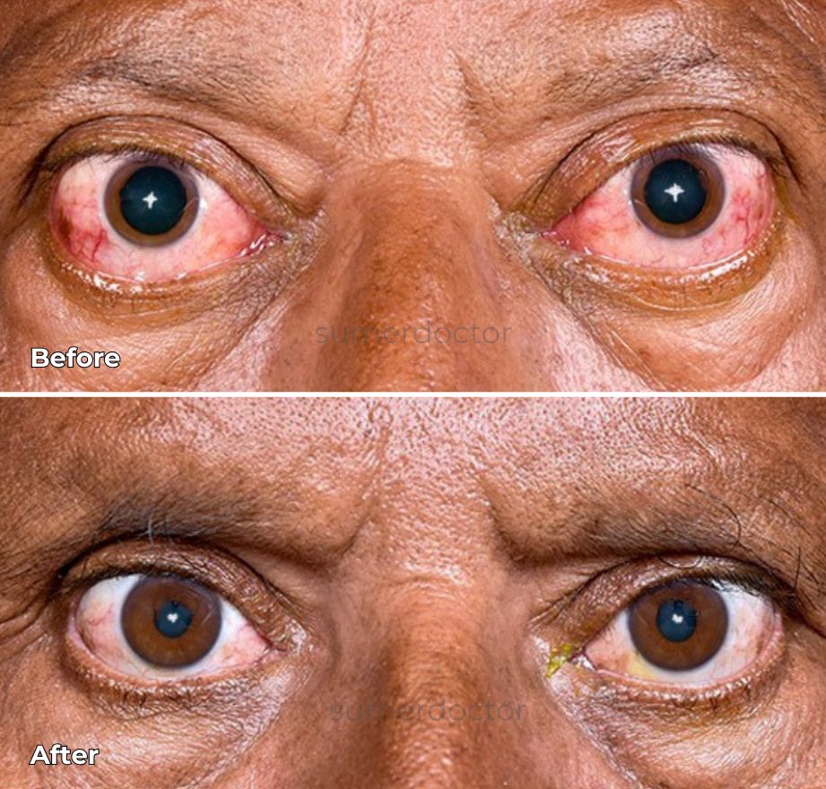 Thyroid Eye Disease management 