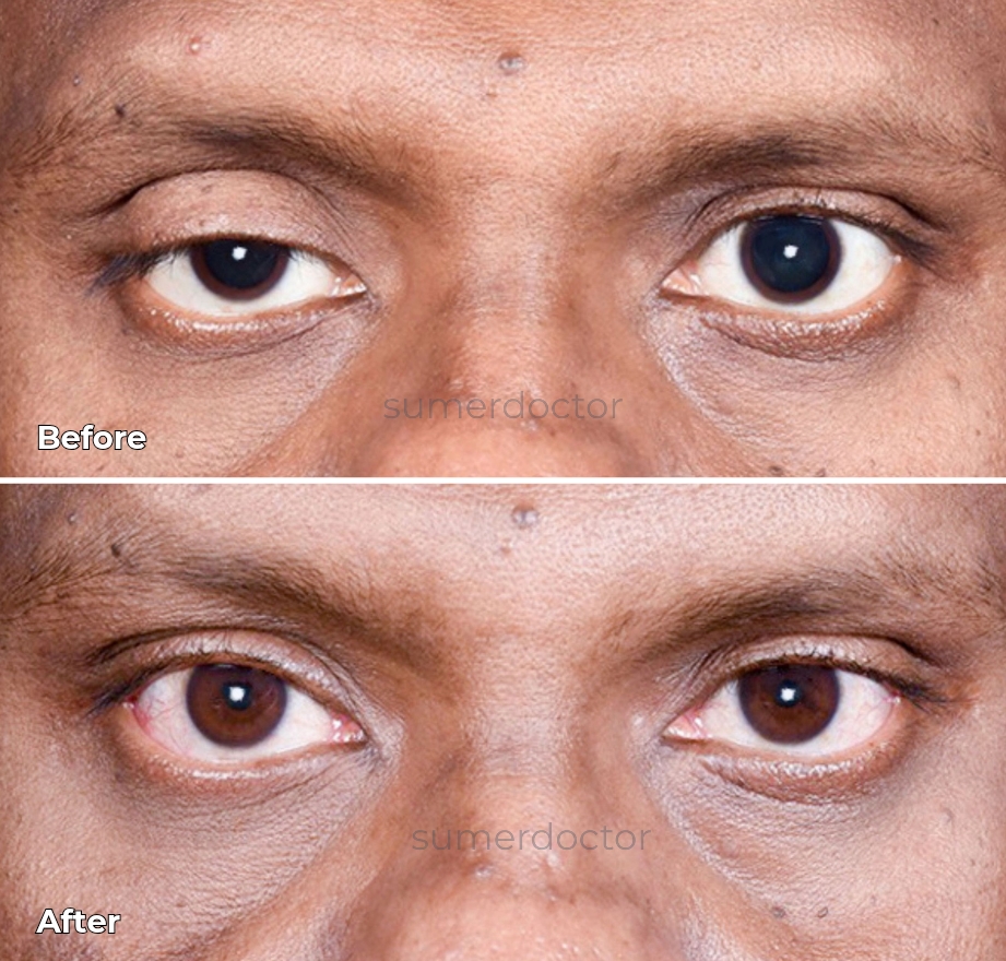 Droopy Eyelid (Ptosis) Repair 