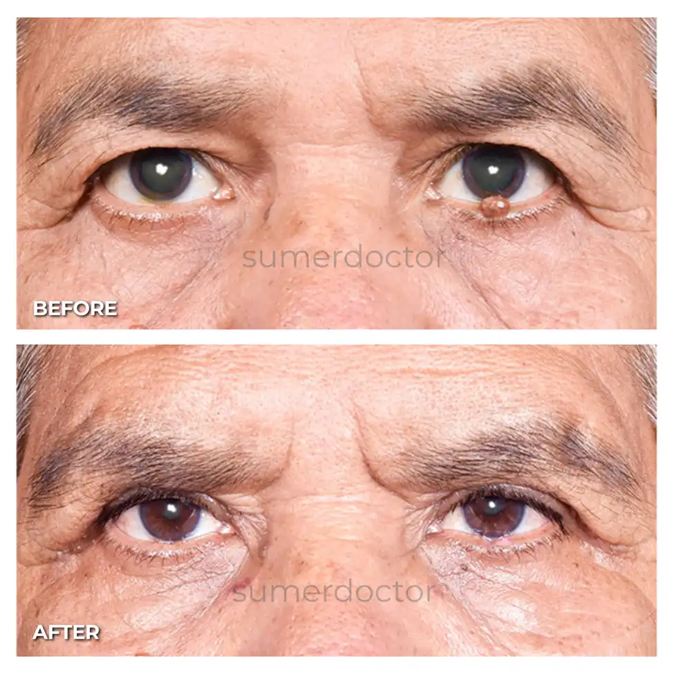What is Oculoplasty? A Beginner’s Guide to Eyelid and Orbital Surgery