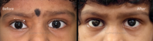 ocular3