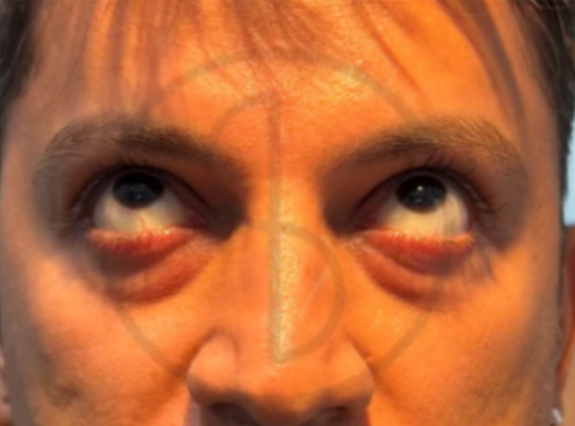 Botox and fillers